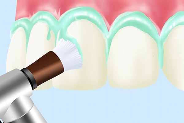 PMTC(Professional Mechanical Tooth Cleaning)